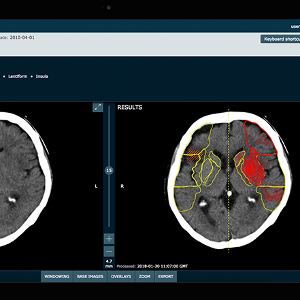 Oxford Spinout Brainomix Secures £7m Investment To Tackle Strokes With ...